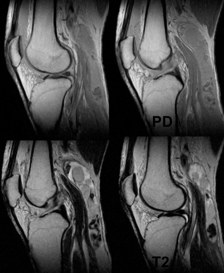 Figure 3 for case Complex baker cyst ( RID3892 )